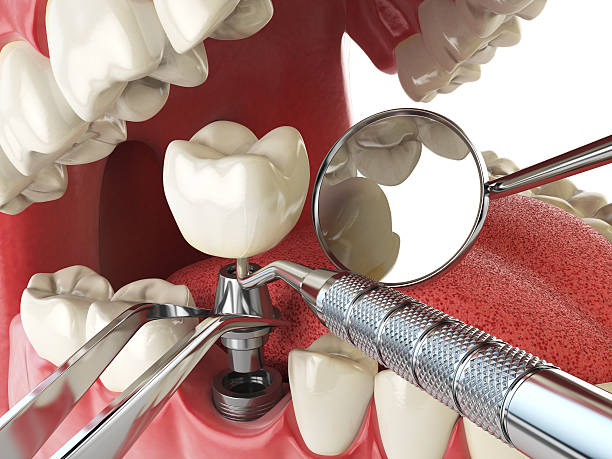 Best Emergency Tooth Extraction in Park View, IA